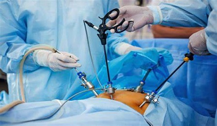 Myomectomy